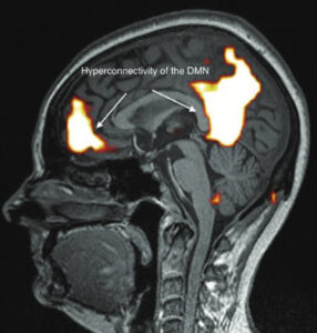 imagen RMf cerebro electrosensible